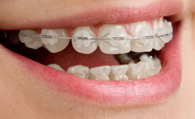 Brackets estéticos de zafiro, Clínica dental Chamberí, Madrid, tratamientos de ortodoncia