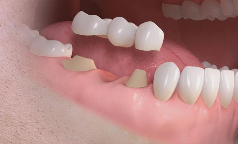 Clínica dental Chamberí Madrid Prótesis dental fija sobre dientes