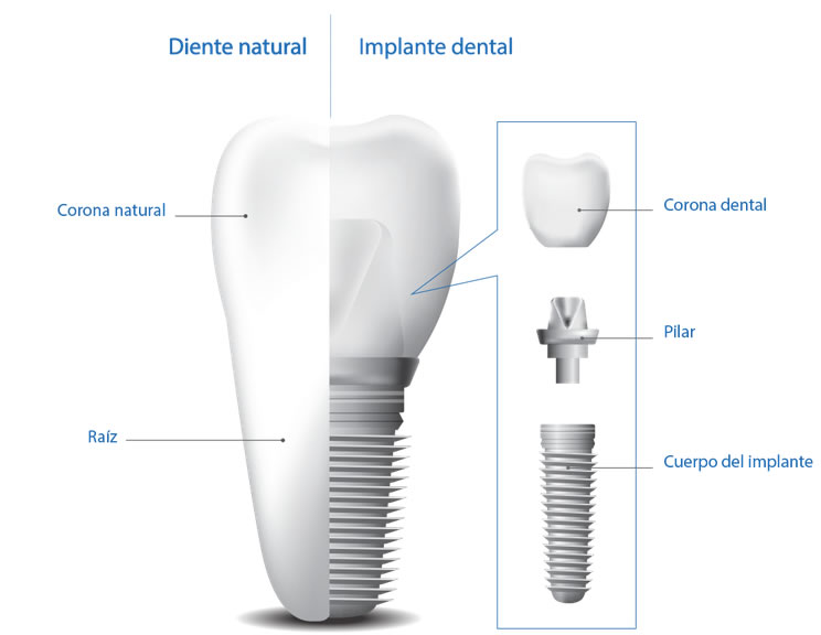 Implante dental Chamberí Clínica dental Dentylife 28015 Madrid 