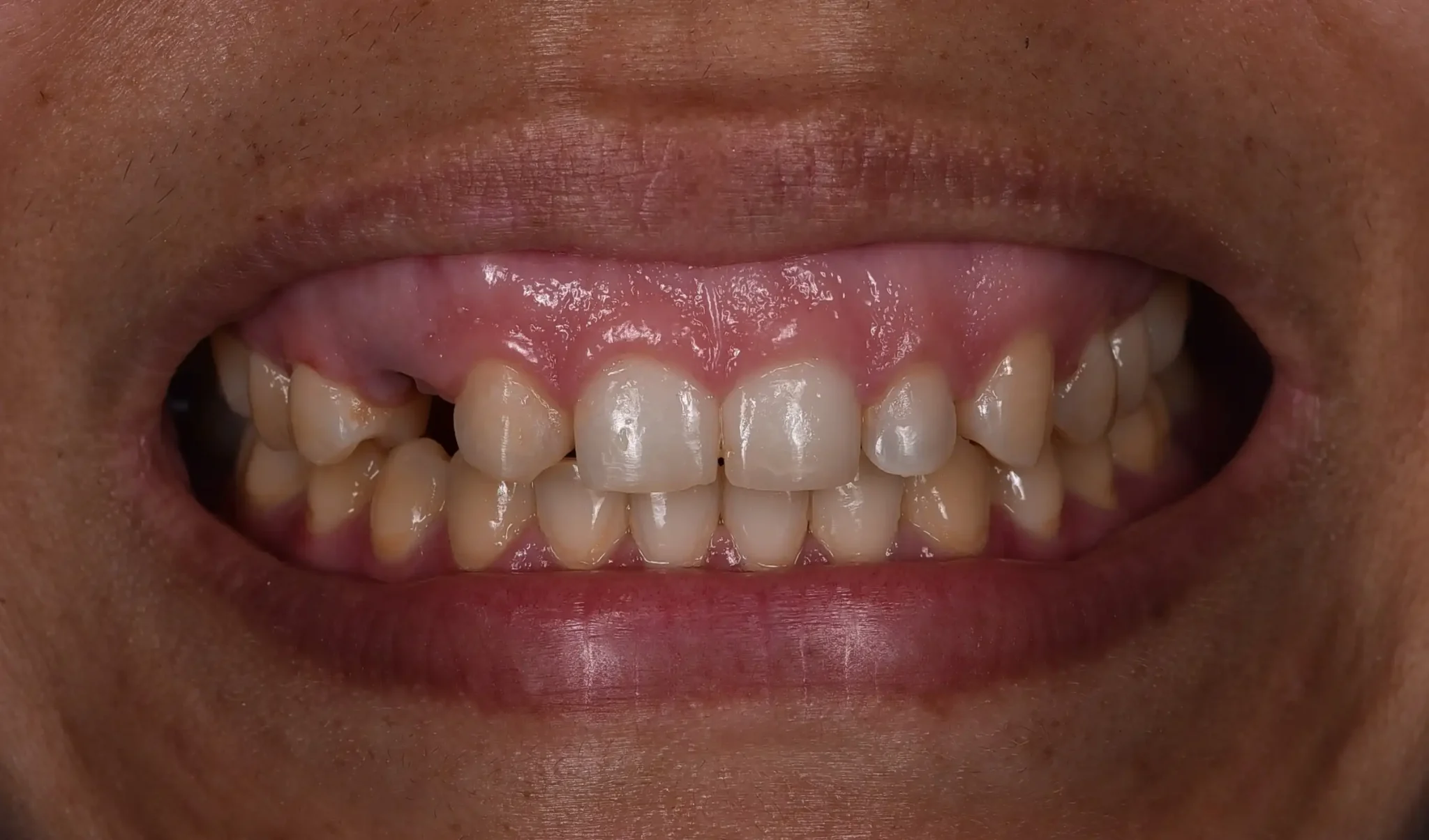 antes-estetica-dental