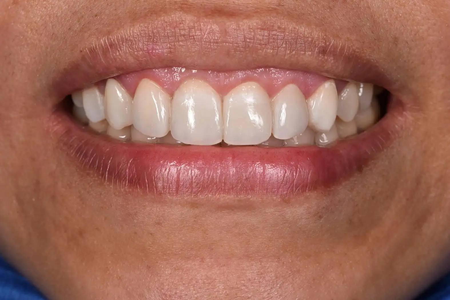 despues-estetica-dental